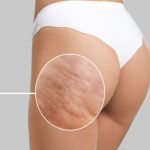 How to Deal with Cellulite?