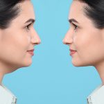 How to Get Rid of Double Chin San Jose