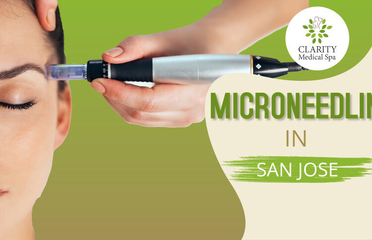 Microneedling in San Jose