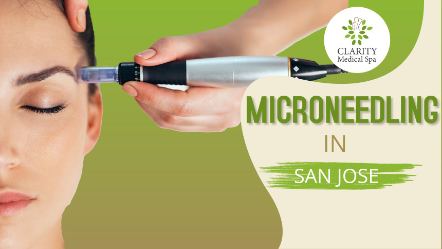 Microneedling in San Jose