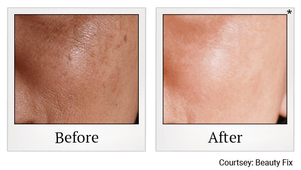 Rejuran before and after