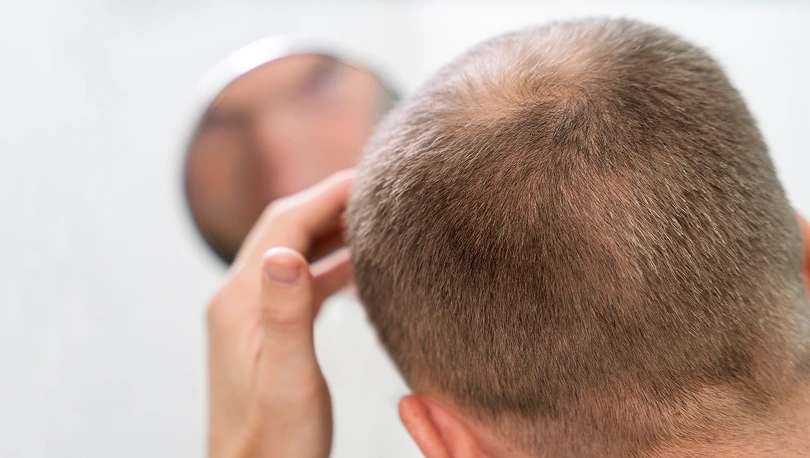 Hair Restoration 1 Hair Restoration 1