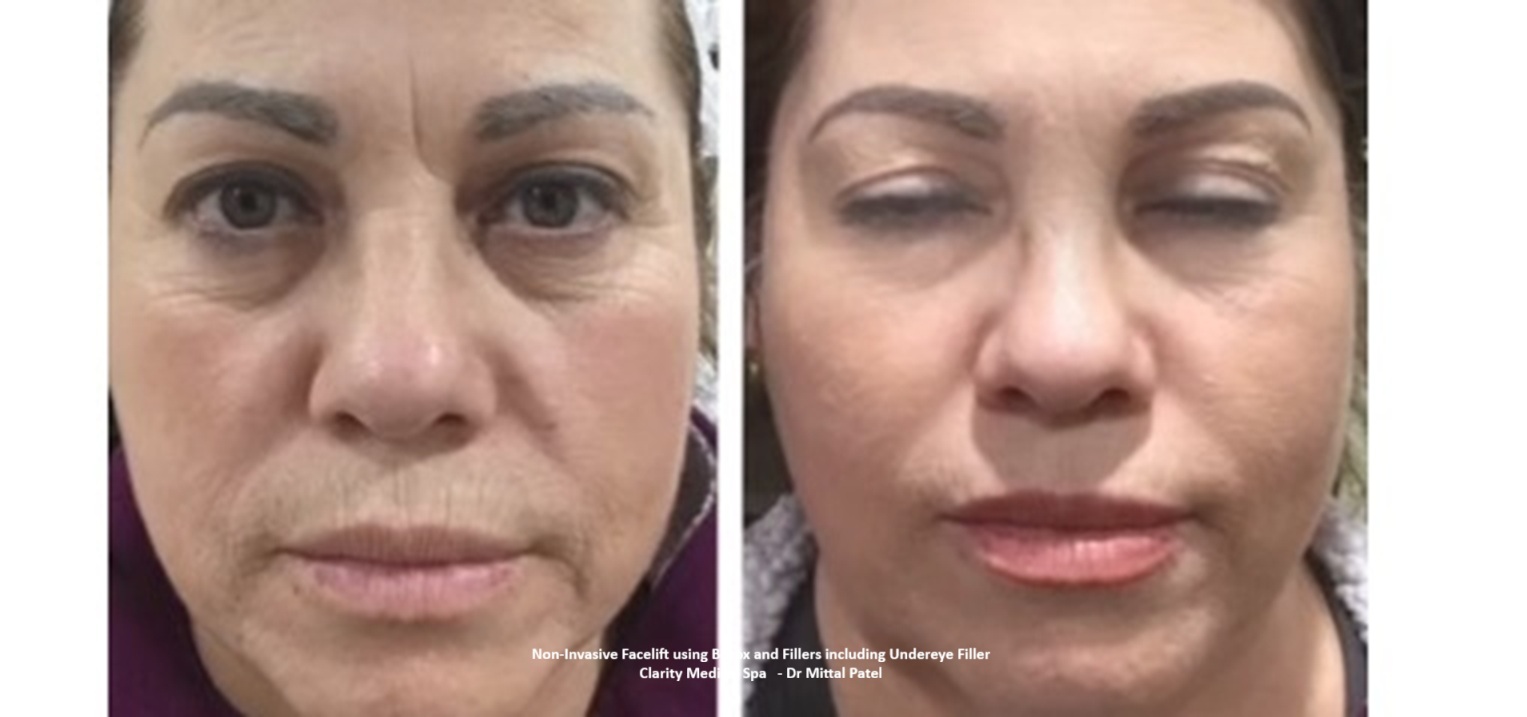 Non invasive Facelift undereye filler