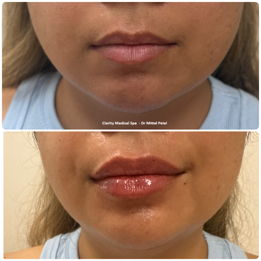 lipjob 3