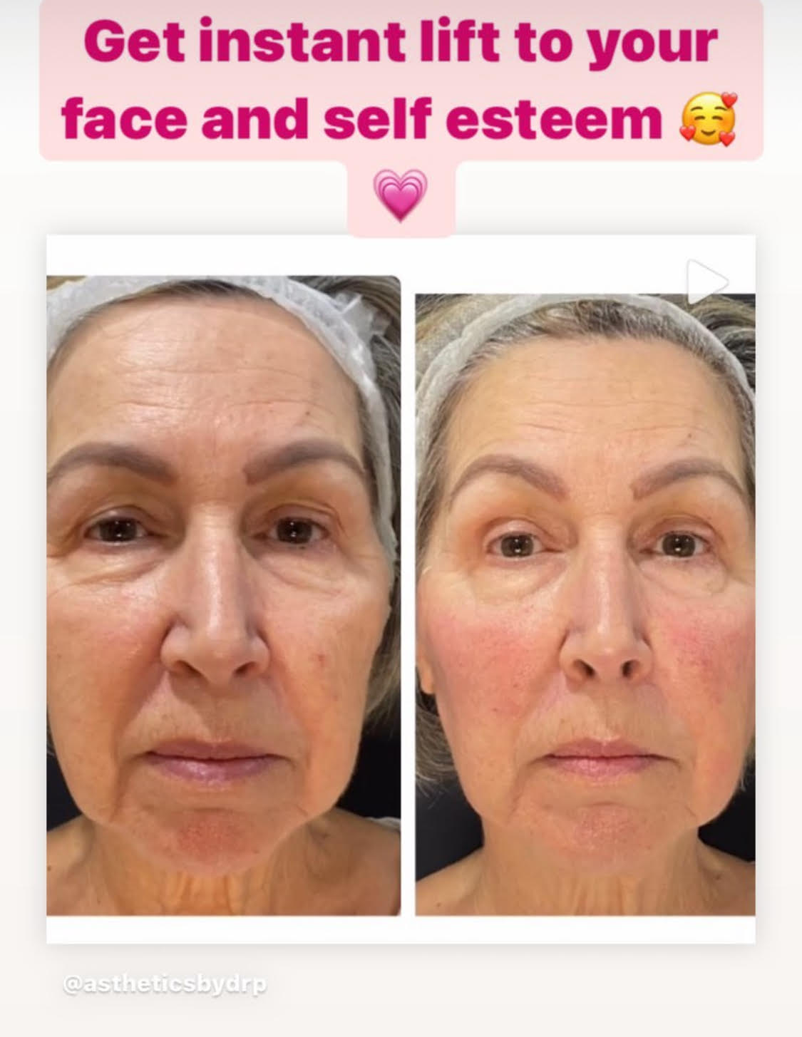 non invasive facelift 5