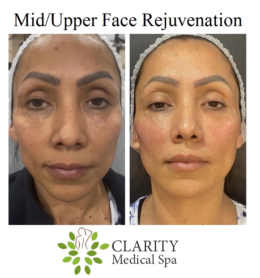 non invasive facelift