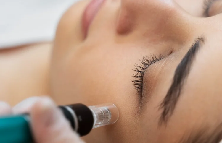 Microneedling vs Chemical